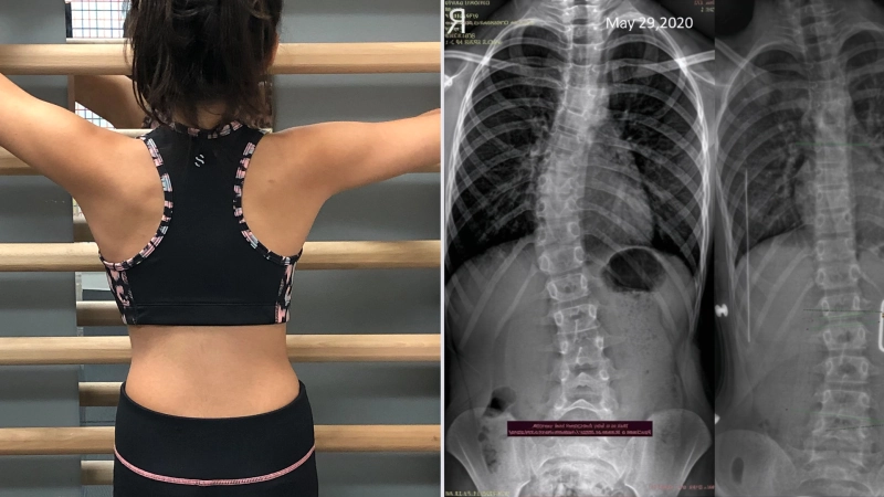 Scoliosis Resources
